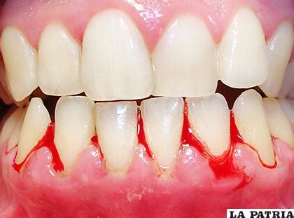 Gingivitis Ulceronecrotizante Aguda Peri Dico La Patria Oruro Bolivia