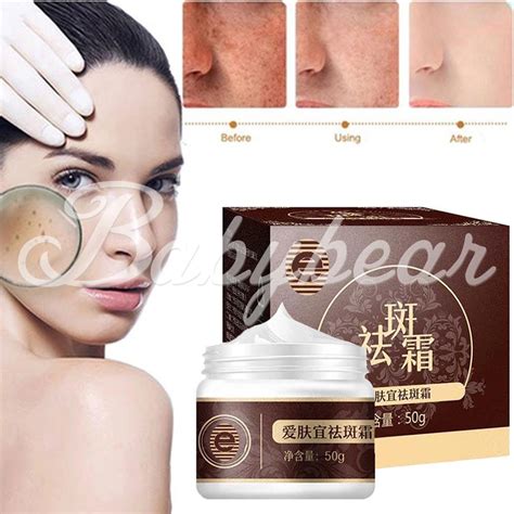 Pomada Para Tirar Sardas - Pomada Branqueadora Para Sardas / Creme Hidratante 50g | Shopee Brasil