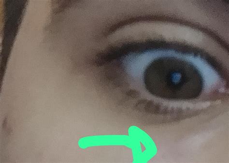 Weird Lump In My Eye Rskincareaddicts