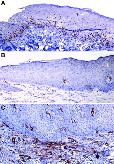 Photomicrograph Of Lred Showing A Ki67 Labeling Index B Cd105 Download Scientific Diagram