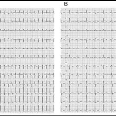 A Twelve Lead Electrocardiogram At The Time Of Presentation To The Download Scientific Diagram