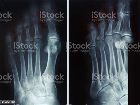 Film Xray Fracture Proximal Phalange At Fifth Toe Stock Photo