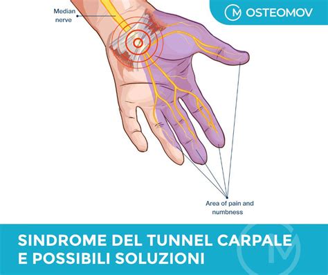 Sindrome Del Tunnel Carpale Osteopata Roma Osteomov