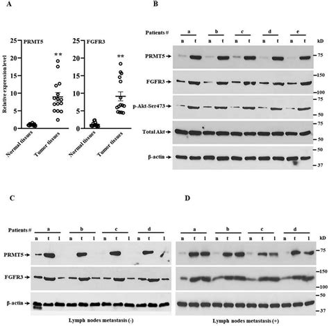 PRMT5 FGFR3 Akt Axis Is Highly Expressed In Human Lung Cancer Tissues