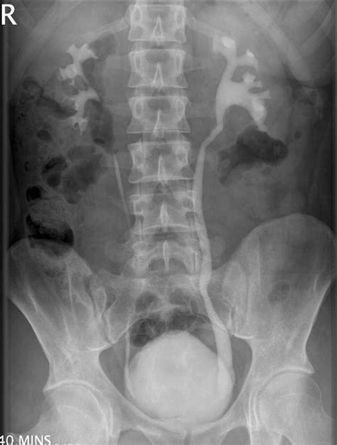 Examination Intravenous Pyelogram - radiology health