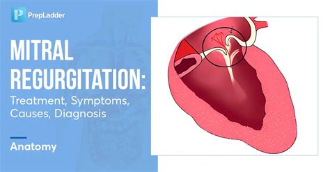 Mitral Regurgitation Treatment Symptoms Causes Diagnosis