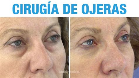 Operaci N De Ojeras Antes Y Despu S Multiestetica