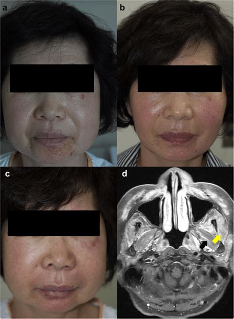 Isolated Facial Edema And Subclinical Facial Muscle Involvement At Download Scientific Diagram