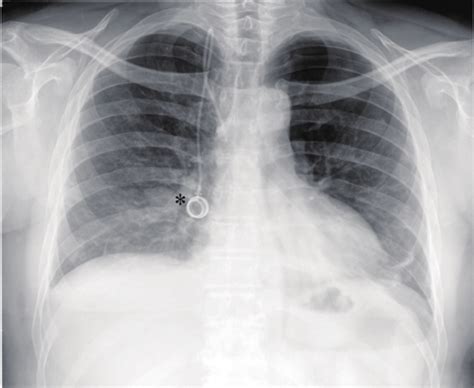 Chest X Ray Performed 24 Hours After Chemical Pleurodesis Confirms