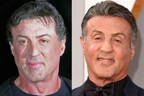 Sylvester Stallone Rifatto Lifting Viso Trapianto Capelli E