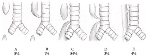 Chapter 20 Esophageal Atresia And Tracheoesophageal Fistula