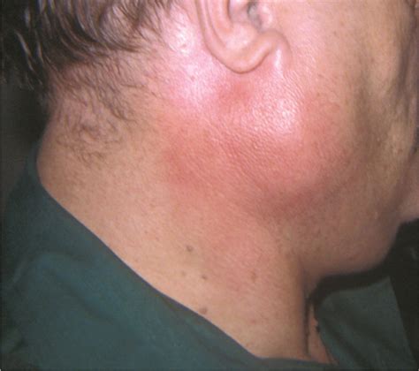 Swollen Parotid Lymph Node