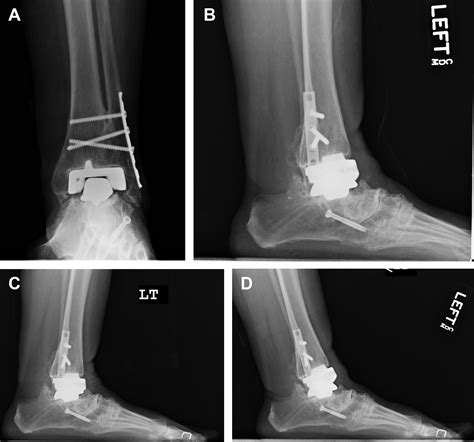 Management Of Talar Component Subsidence Foot And Ankle Clinics