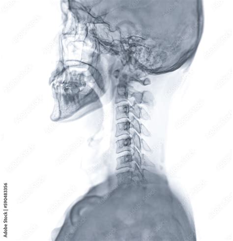 X-ray C-spine or x-ray image of Cervical spine lateral view for diagnostic intervertebral disc ...