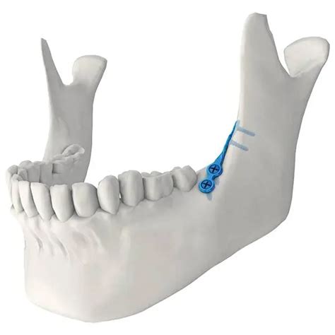 Anatomical Locking Maxillofacial Mini Straight Bridge Plate Credible