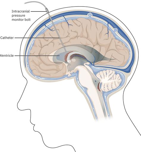 153 Hemorrhagic Stroke Medical Surgical Nursing Openstax