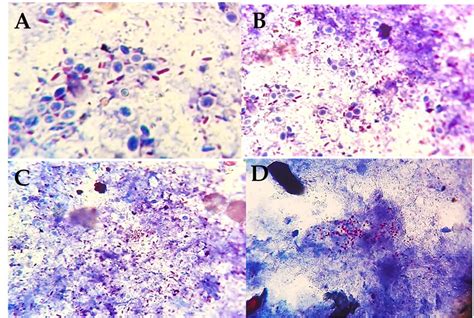 Arrangement Of Acid Fast Bacilli In Faecal Smears Zn ×1000 A Few Download Scientific