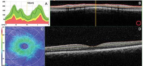 Quantification Of Vascular And Neuronal Changes In The Peripapillary