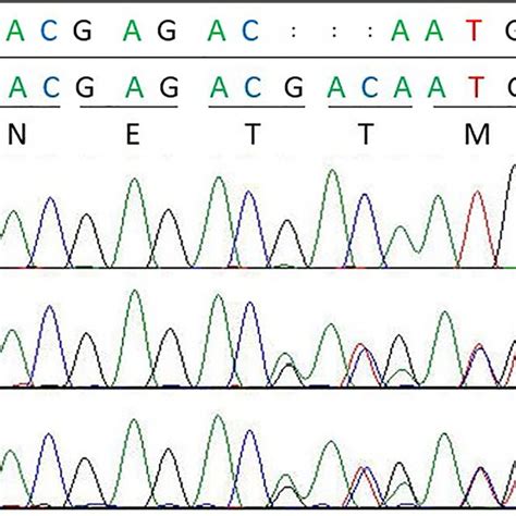 Identification Of A Novel Mutation Of The CTSC Gene Direct Automated