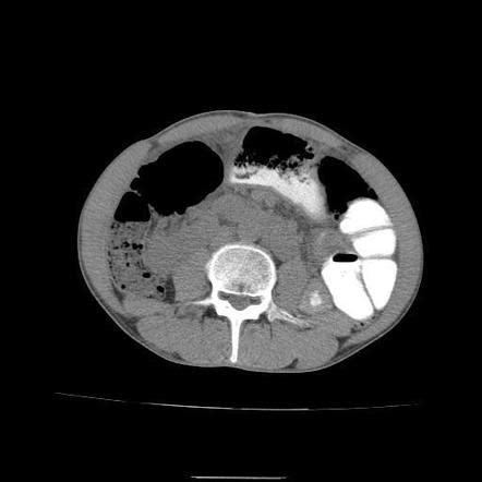 Gastric Gastrointestinal Stromal Tumour Radiology Case Radiopaedia Org