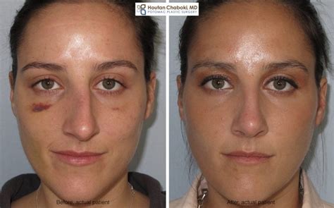 Broken Nose Repair Restoring And Improving Nasal Form