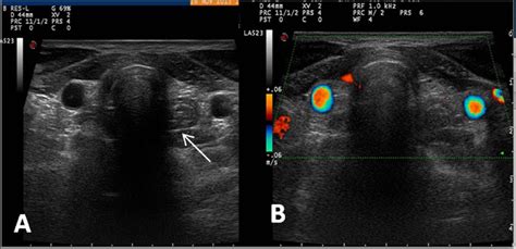 Midline Ectopic Thyroid Mimicking As A Thyroglossal Duct Cyst Manju