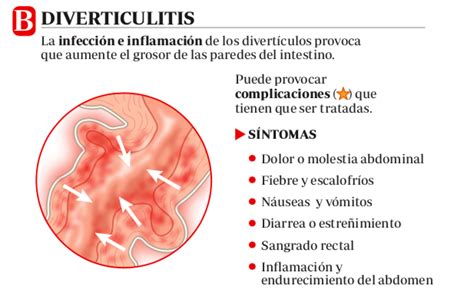 ¿qué Es La Diverticulosis¿y La Diverticulitis Hidden Nature