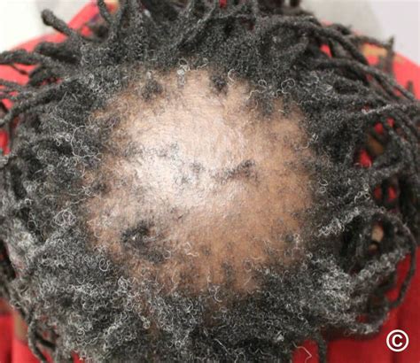 Central Centrifugal Cicatricial Alopecia