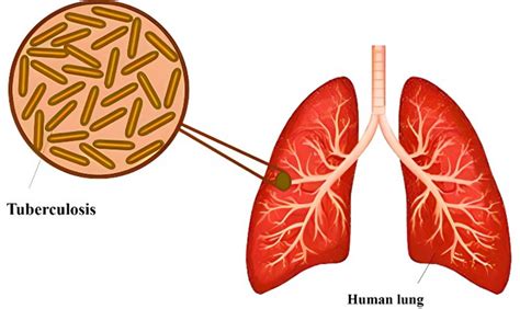 Tuberculosis Lungs Diagram