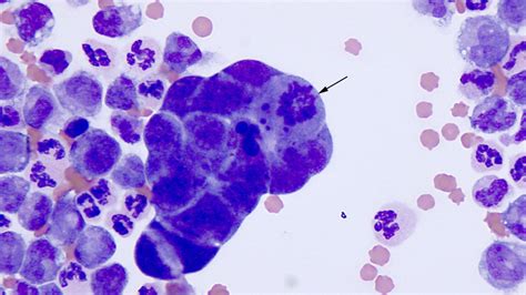 Mesothelioma Vs Reactive Mesothelial Cells Cytology 2022E Jurnal