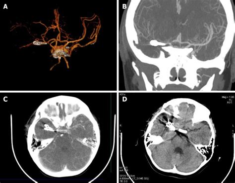 Treatment Of Pediatric Intracranial Dissecting Aneurysm With Clipping