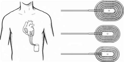 Epicardial Pacemaker Implantation Ranchi,Pacemaker Surgery Ranchi