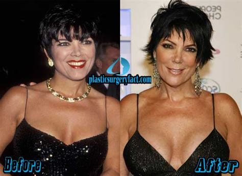 Kris Jenner Plastic Surgery Before and After Photos