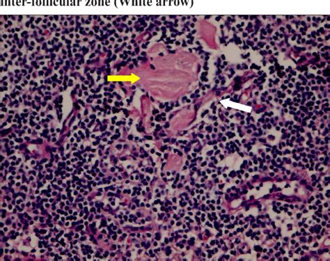 Figure 1 From Castleman S Disease In A Kidney Failure Patient Diagnosed