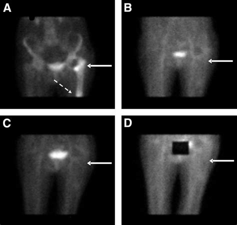 A Focally Increased M Tc Mdp Uptake During Skeletal Phase In Upper