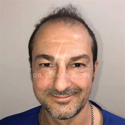 Hair Transplant Turkey Patient Journey Dr Serkan Aygin Clinic