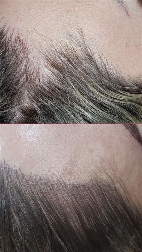 Scalp Micropigmentation - The Derma Face