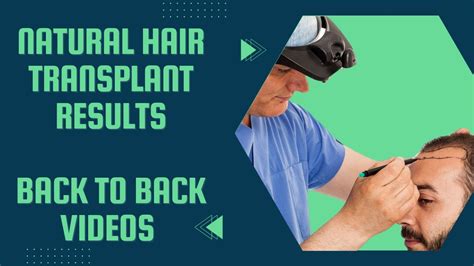 Top Rated Hair Transplant Clinic In Mysore Back To Back Successful