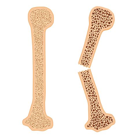 Qu Es Realmente La Osteoporosis