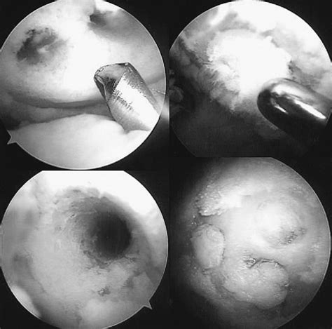 Figure From Osteochondral Multiple Autograft Transfer Omat For The