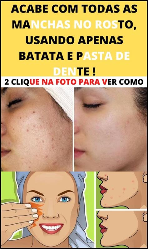 Truque Simples De Como Remover As Manchas Do Rosto Em 1 Dia In 2020