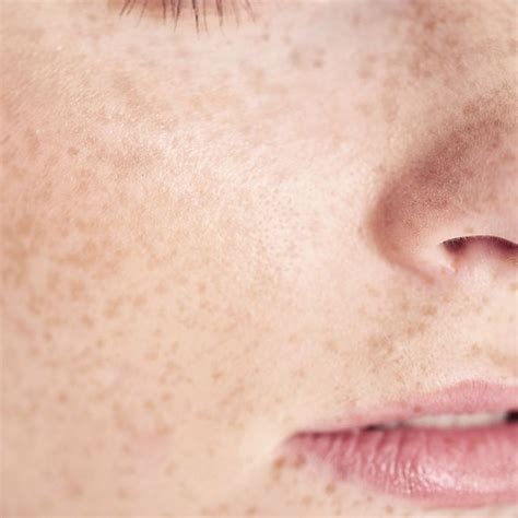 Moles Vs Freckles Understanding The Difference