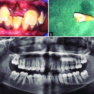 Radiographic Evaluation Of Reimplanted Avulsed Tooth 11 After 1 Week