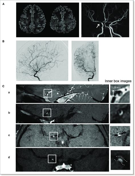 A typical example of intracranial atherosclerosis and the RNF213 ...