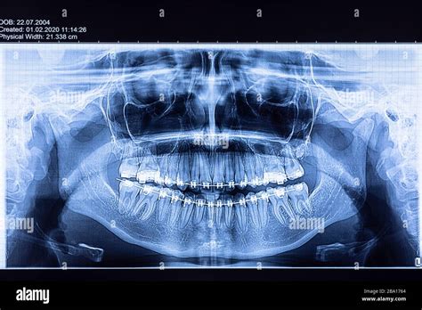 Dental x-ray with braces. Radiography for teeth straightening and dental structures research ...