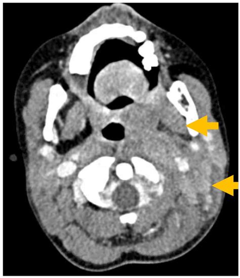 CT taken on admission showing enlargement of the left palatine tonsil ...