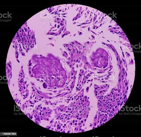 Kanker Kandung Kemih Karsinoma Sel Transisi Menunjukkan Neoplasma Ganas