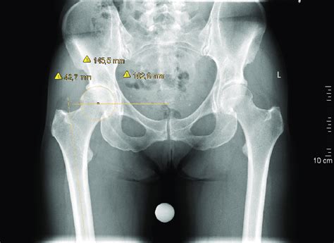 Standard Ap Pelvic Radiograph With The Plotted Femoral Offset 427