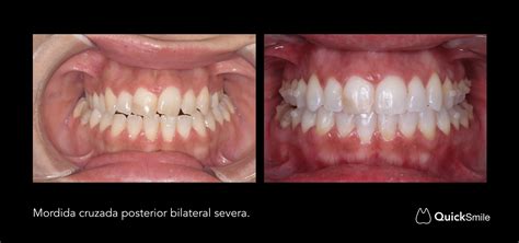 Caso Cl Nico Mordida Cruzada Posterior Bilateral Severa