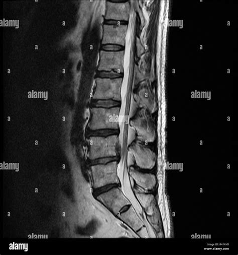 Lumbar Spine Mri Bulged Disc